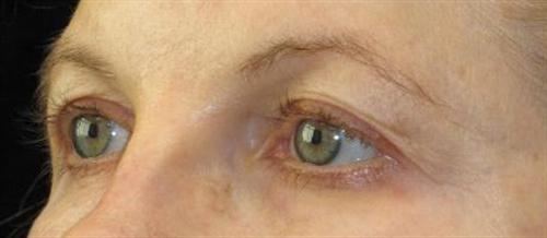 Eyelid Surgery Patient Photo - Case 46 - before view-1