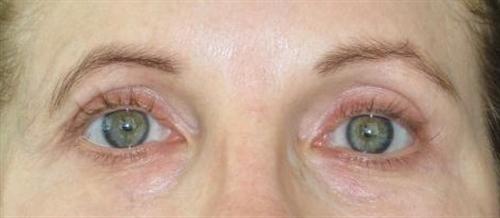 Eyelid Surgery Patient Photo - Case 46 - after view