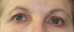 Eyelid Surgery - Case 46 - Before