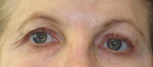 Eyelid Surgery Patient Photo - Case 46 - before view-