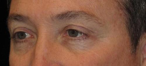 Eyelid Surgery Patient Photo - Case 45 - before view-1