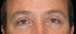 Eyelid Surgery - Case 45 - After