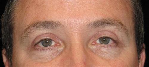 Eyelid Surgery Patient Photo - Case 45 - after view