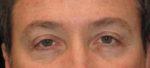 Eyelid Surgery - Case 45 - Before