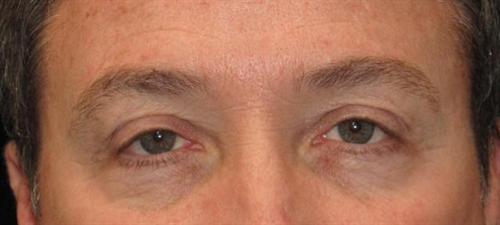 Eyelid Surgery Patient Photo - Case 45 - before view-0