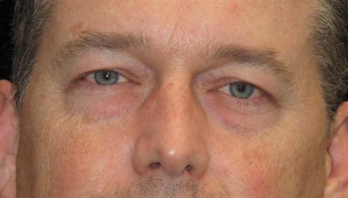 Eyelid Surgery Patient Photo - Case 51 - before view-0