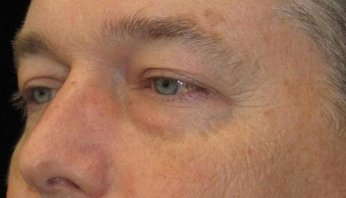 Eyelid Surgery Patient Photo - Case 51 - before view-1