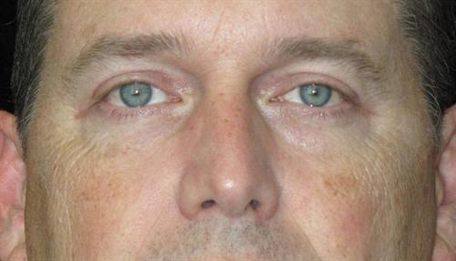 Eyelid Surgery Patient Photo - Case 51 - after view