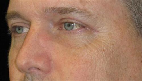 Eyelid Surgery Patient Photo - Case 51 - after view-1