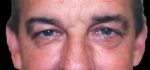 Eyelid Surgery - Case 35 - Before