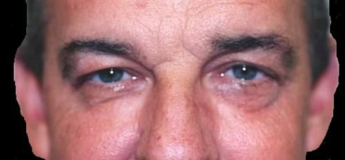 Eyelid Surgery Patient Photo - Case 35 - before view-0