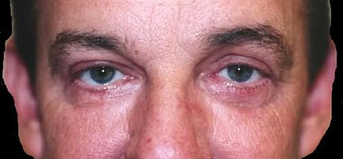 Eyelid Surgery Patient Photo - Case 35 - after view