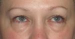 Eyelid Surgery - Case 1 - Before