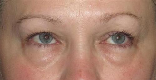 Eyelid Surgery Patient Photo - Case 1 - before view-0