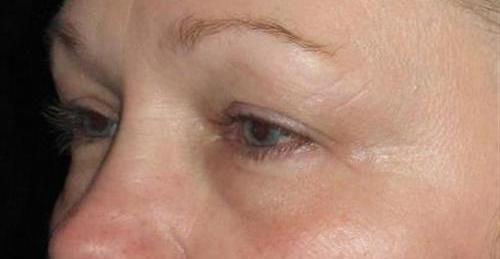 Eyelid Surgery Patient Photo - Case 1 - before view-1
