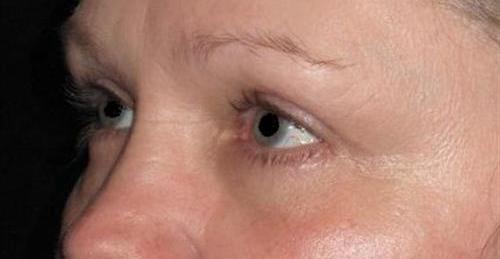 Eyelid Surgery Patient Photo - Case 1 - after view-1