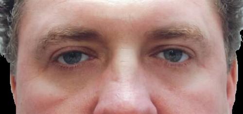 Eyelid Surgery Patient Photo - Case 32 - after view