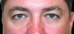 Eyelid Surgery - Case 32 - Before
