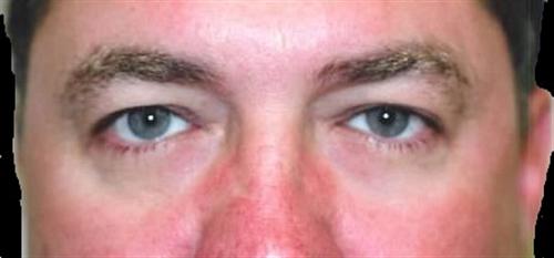 Eyelid Surgery Patient Photo - Case 32 - before view-