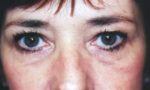 Eyelid Surgery - Case 34 - Before