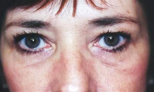 Eyelid Surgery Patient Photo - Case 34 - before view-
