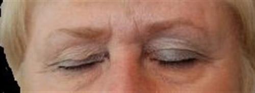 Eyelid Surgery Patient Photo - Case 33 - before view-1