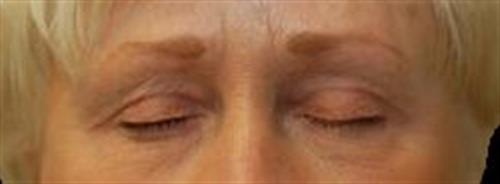 Eyelid Surgery Patient Photo - Case 33 - after view-1