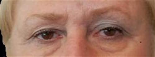 Eyelid Surgery Patient Photo - Case 33 - before view-