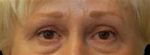 Eyelid Surgery - Case 33 - After