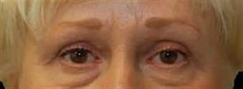 Eyelid Surgery Patient Photo - Case 33 - after view-0