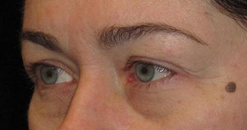 Eyelid Surgery Patient Photo - Case 40 - before view-1