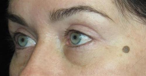 Eyelid Surgery Patient Photo - Case 40 - after view-1