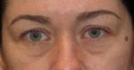 Eyelid Surgery - Case 40 - Before
