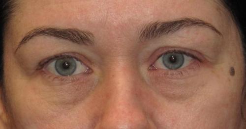 Eyelid Surgery Patient Photo - Case 40 - before view-