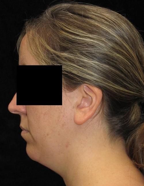 Facial Liposuction Patient Photo - Case 57 - before view-1