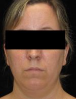 Facial Liposuction - Case 57 - Before