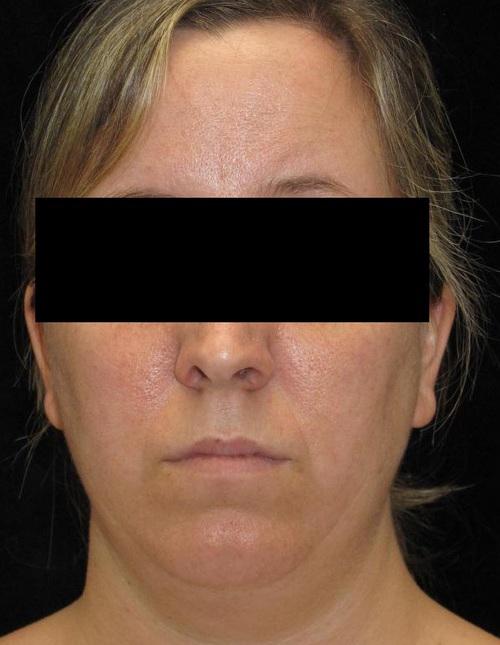 Facial Liposuction Patient Photo - Case 57 - before view-
