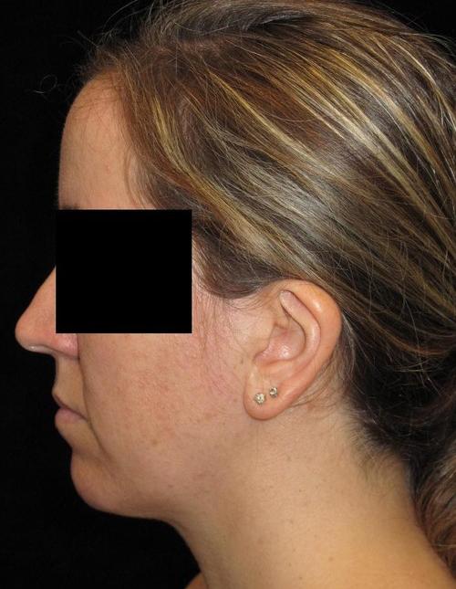 Facial Liposuction Patient Photo - Case 57 - after view-1