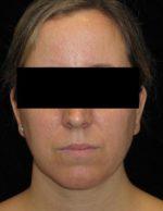 Facial Liposuction - Case 57 - After