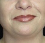 Facial Liposuction - Case 56 - Before