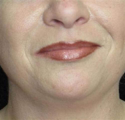 Facial Liposuction Patient Photo - Case 56 - before view-0