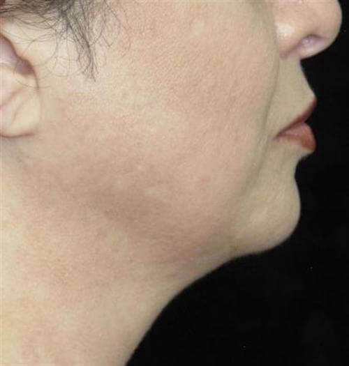 Facial Liposuction Patient Photo - Case 56 - before view-1