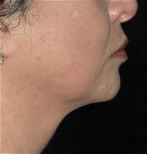 Facial Liposuction Patient Photo - Case 56 - after view-1