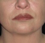 Facial Liposuction - Case 56 - After
