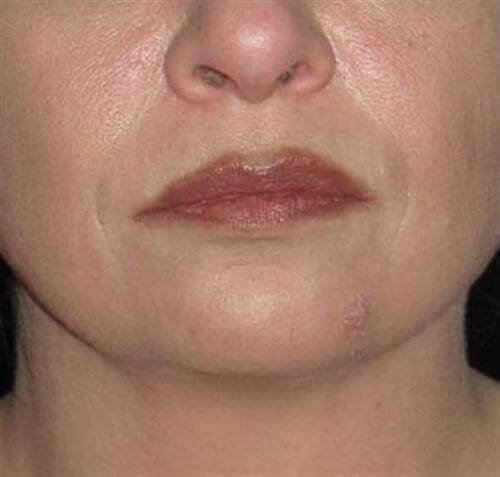 Facial Liposuction Patient Photo - Case 56 - after view
