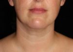 Facial Liposuction - Case 232 - After