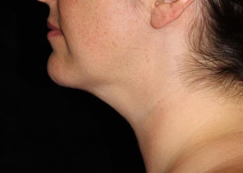Facial Liposuction Patient Photo - Case 232 - after view-1