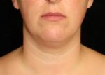 Facial Liposuction - Case 232 - Before