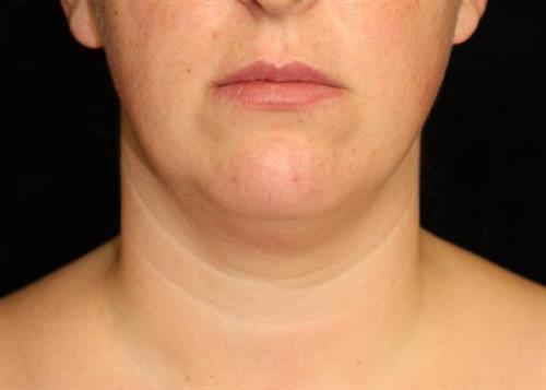Facial Liposuction Patient Photo - Case 232 - before view-