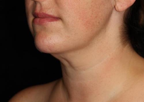 Facial Liposuction Patient Photo - Case 232 - after view-2